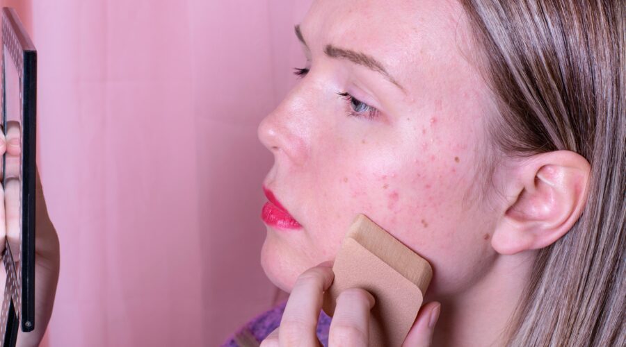 Mulher com acne fazendo esfoliação