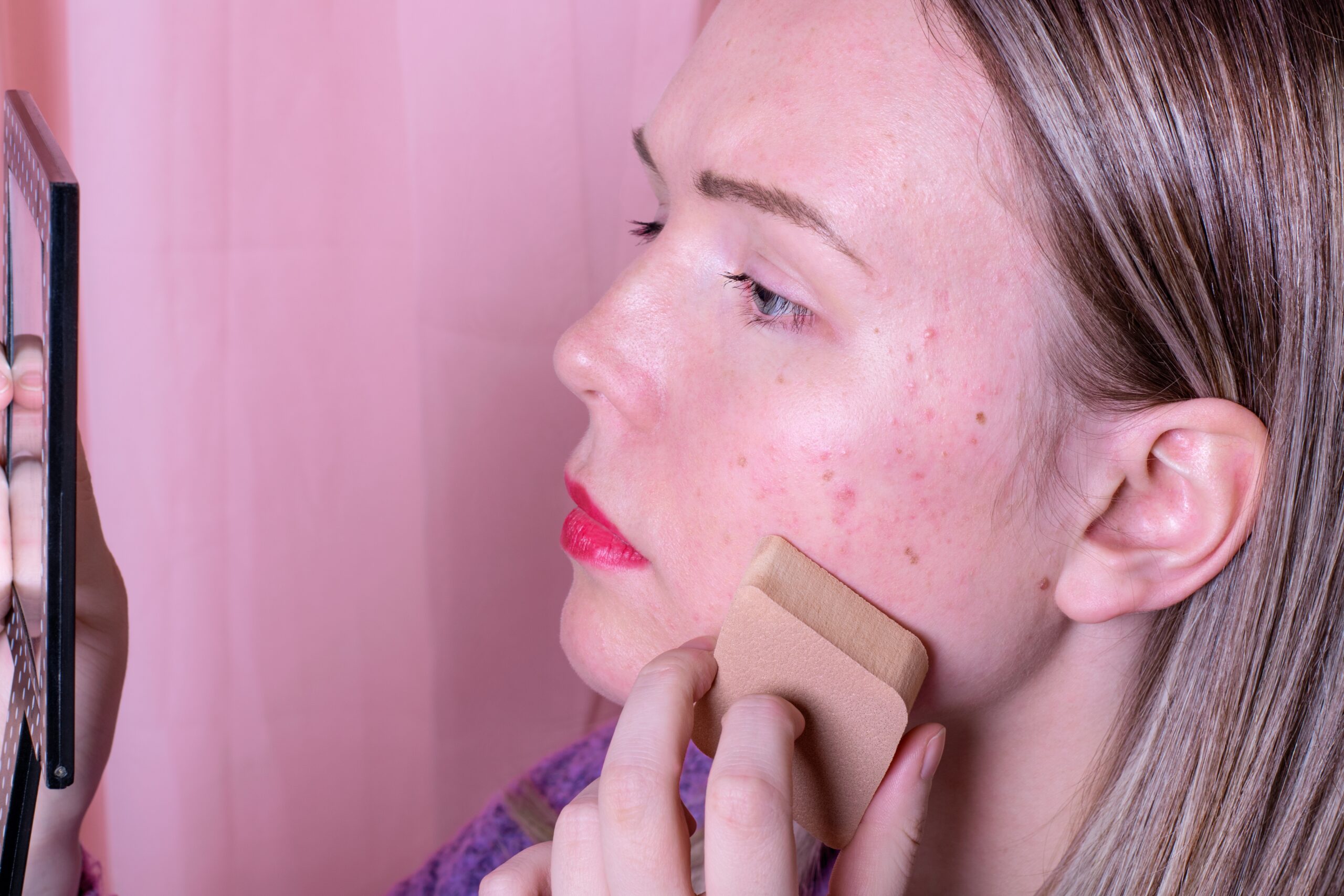 Mulher com acne fazendo esfoliação