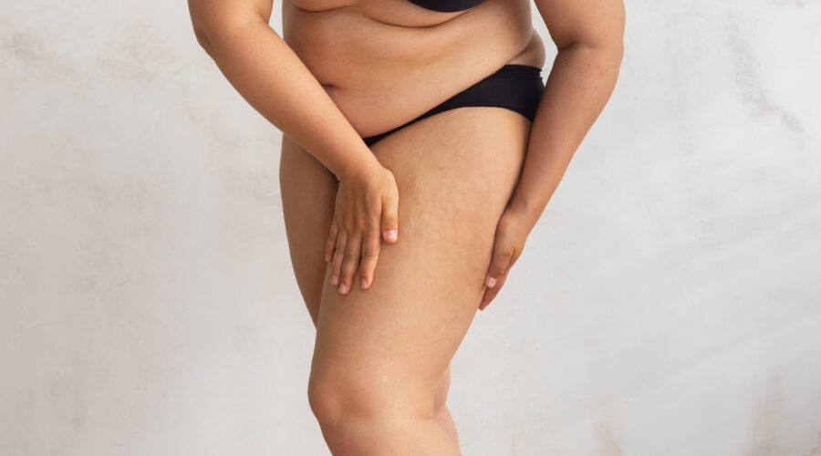 Mulher com celulite nas pernas